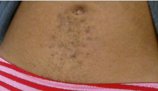 Young woman with pigmentation from ingrown hairs gets laser hair removal